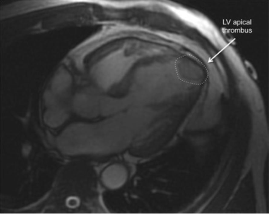 Miocardiopatía de takotsubo con trombo apical