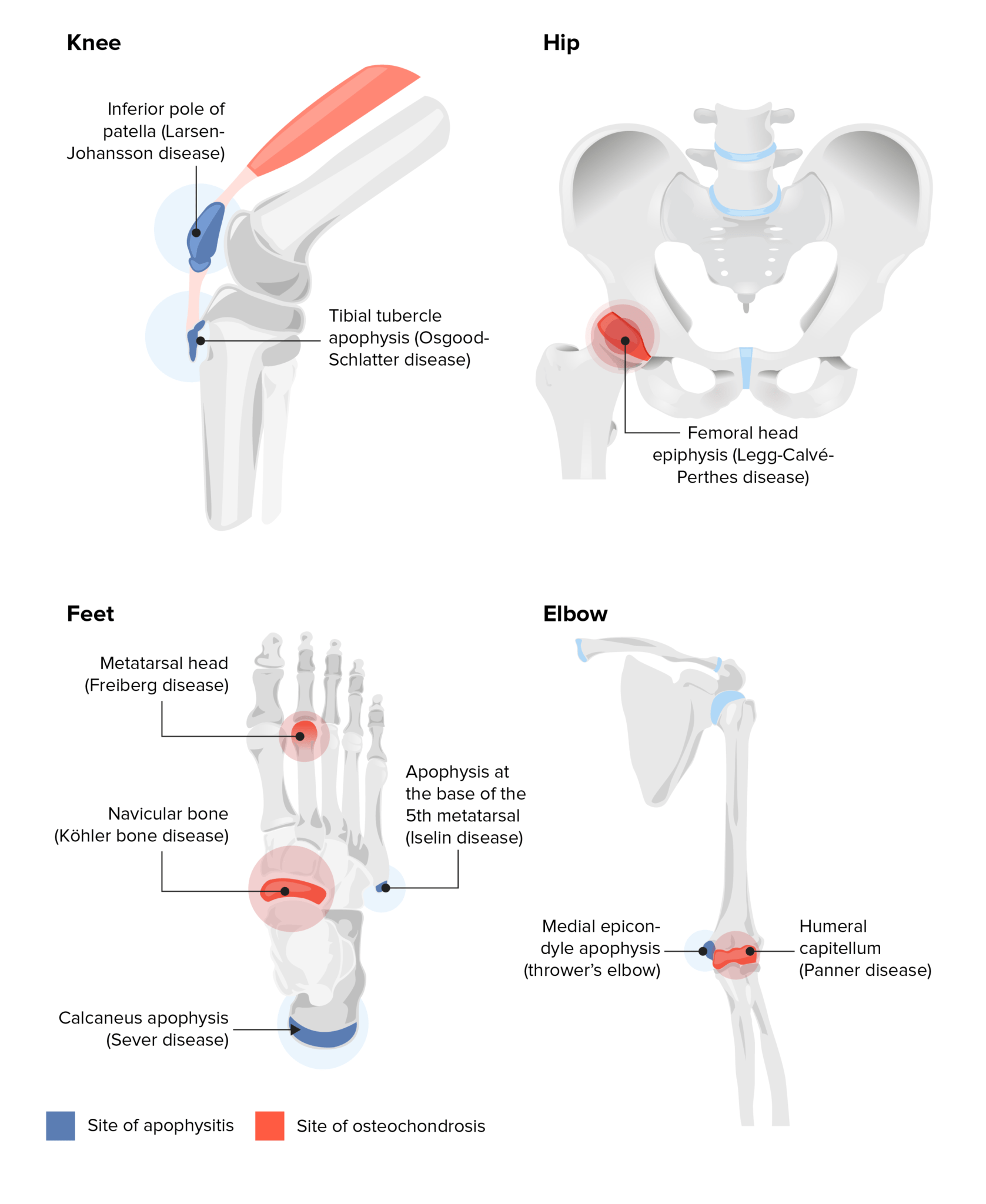 Chronic Apophyseal Injury Concise Medical Knowledge