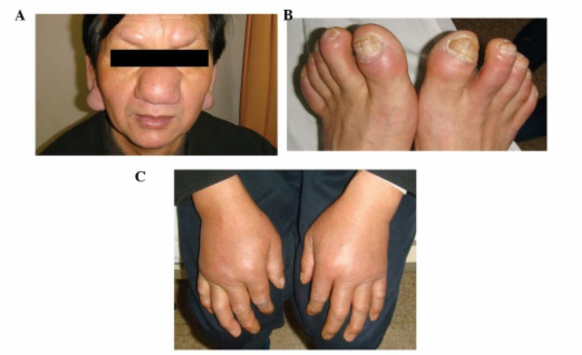 Appearance of a patient with a rare chronic lymphocytic leukemia