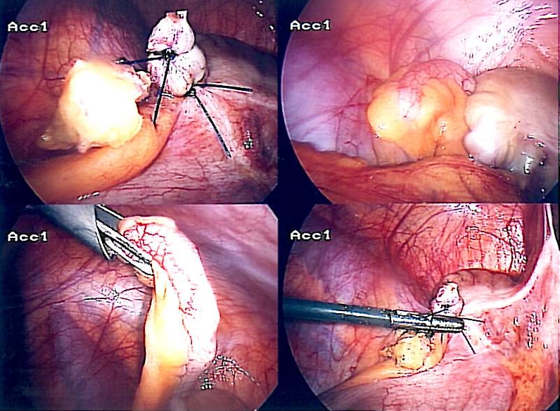 Appendix-entfernung
