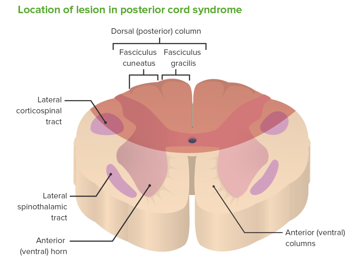 Area affected by posterior cord syndrome