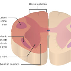 Area of spinal cord affected by BSS
