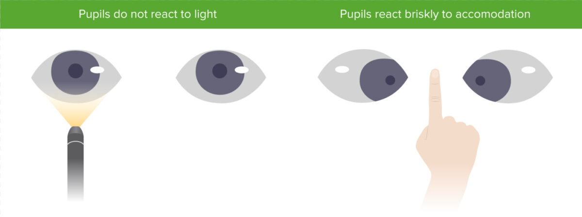 argyll robertson pupil symptoms