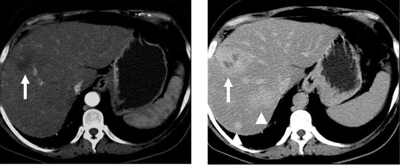 Arterial and portal venous phase ct of cholangiocarcinoma