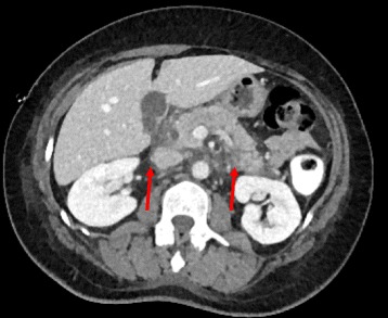 Arterial phase contrast ct showing an acute pancreatitis
