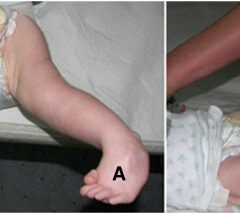 Arthrogryposis in infant Oligohydramnios