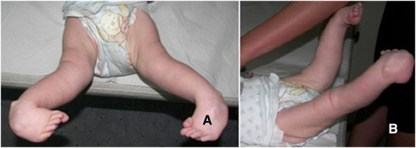 Arthrogryposis in infant oligohydramnios