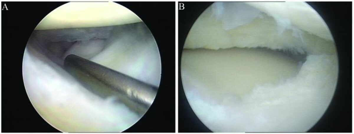 Arthroscopy with meniscus repair