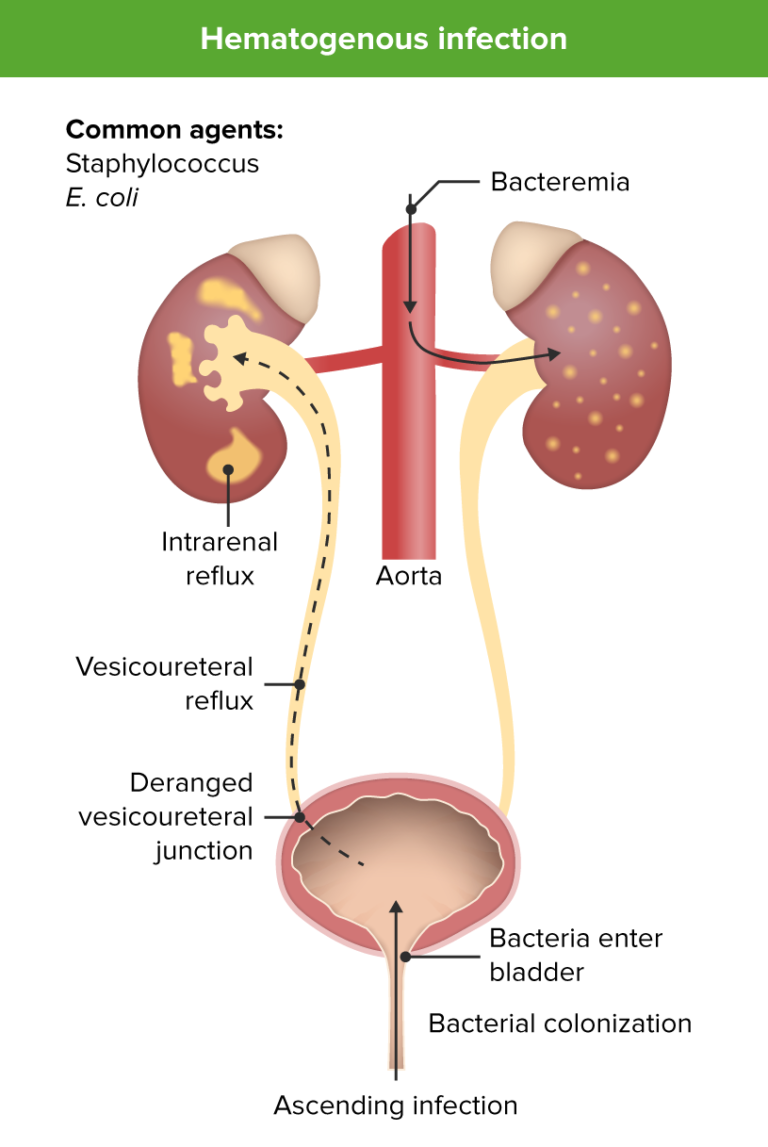Urinary Tract Infections (UTIs) in Children Concise Medical Knowledge