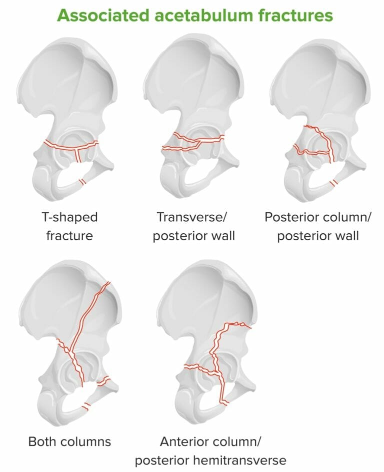 Pelvic Fractures | Concise Medical Knowledge