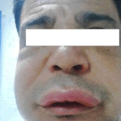 Asymmetrical swelling of the face and lips due to angioedema