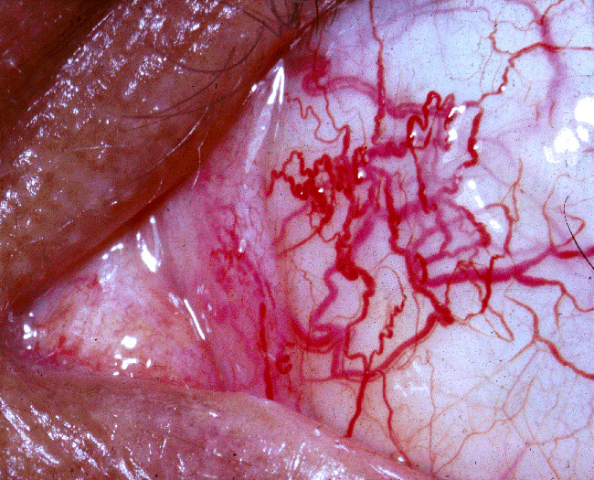 ataxia telangiectasia skin