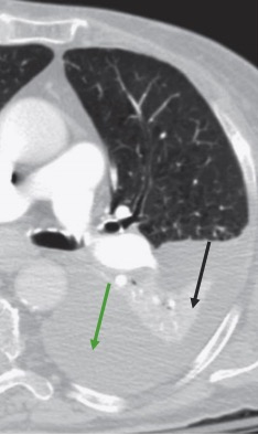Atelectasis on chest ct