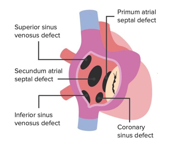 Atrial Septal Defect Asd Concise Medical Knowledge 4914