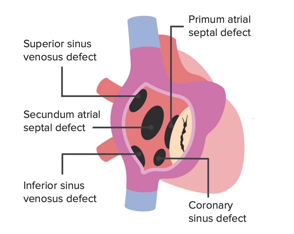 Atrial septal defects locations