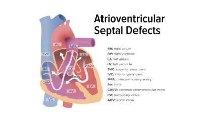 Atrioventricular septal defect feature