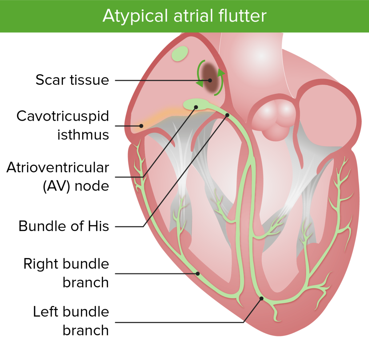 difference between typical and atypical atrial flutter