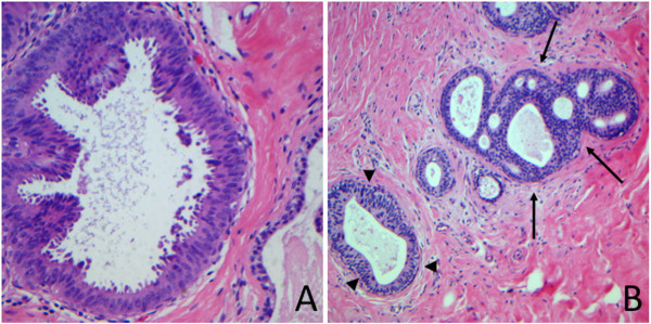 Atypical ductal hyperplasia