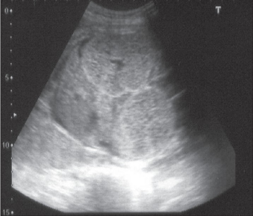 Autosomal recessive polycystic kidney disease diagnosed in fetus