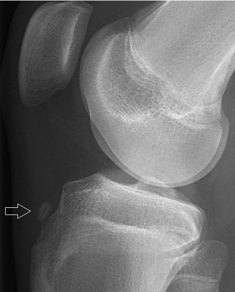 Avulsion fracture of the tibial tuberosity