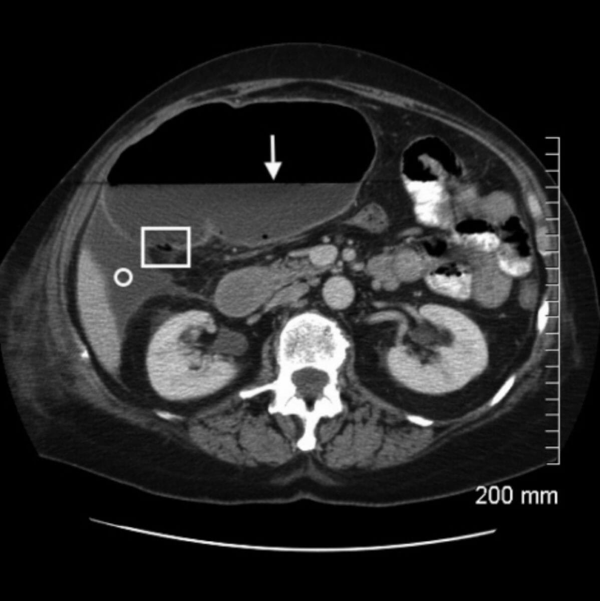 Axial ct image with intravenous and oral contrast through the level of the mid-abdomen demonstrates massive dilatation of the cecum
