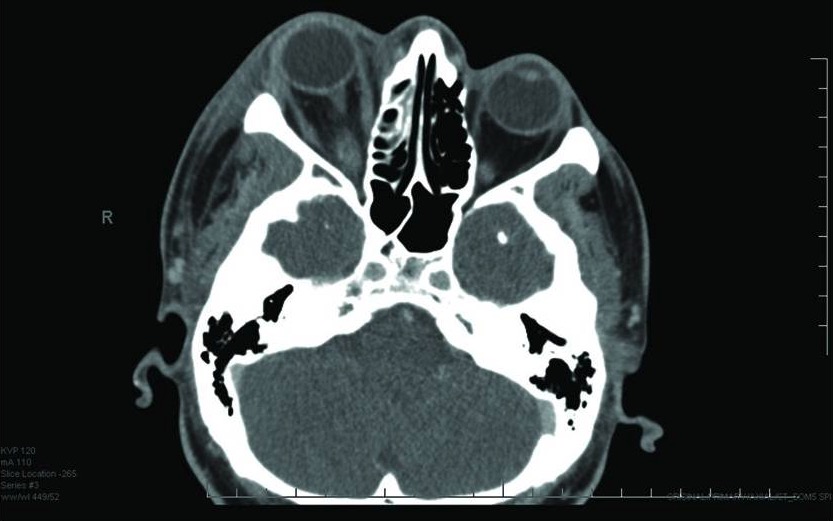 La tomografía computarizada axial muestra proptosis derecha e inflamación de los tejidos blandos de la cara