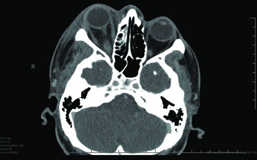 Celulite Pré-Septal (Periorbitária): o que é, como diagnosticar e tratar