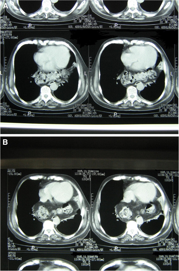 Axial ct scan of diaphragmal hernia