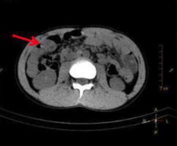 Axial spect:ct image of the meckel’s diverticulum