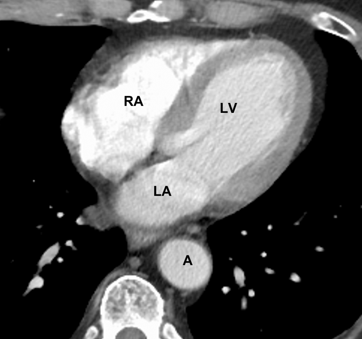 Axial chest ct visualizing the heart chambers