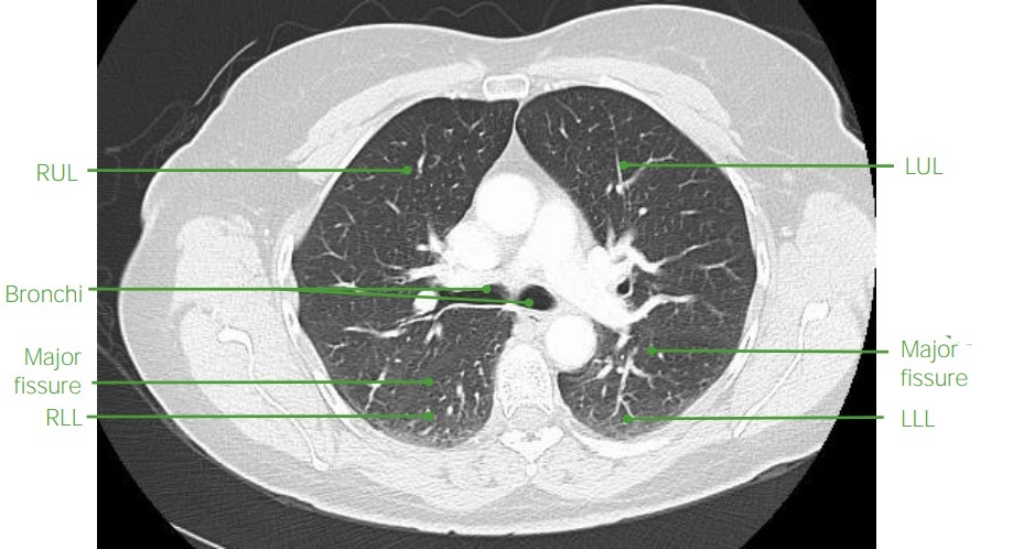 Axial chest ct with contrast anatomy with labels