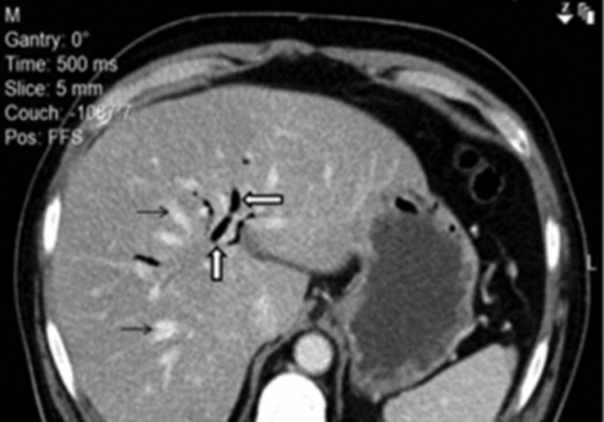 Imagem axial de tomografia computadorizada com contraste do abdome do paciente revelando pneumobilia