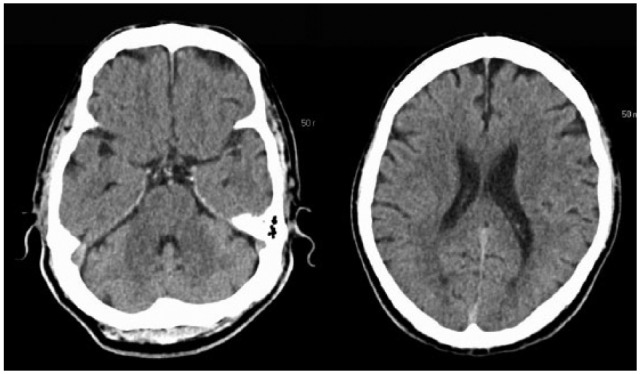 Tomografia computadorizada, em corte axial, de um doente com acidente vascular cerebral isquémico agudo