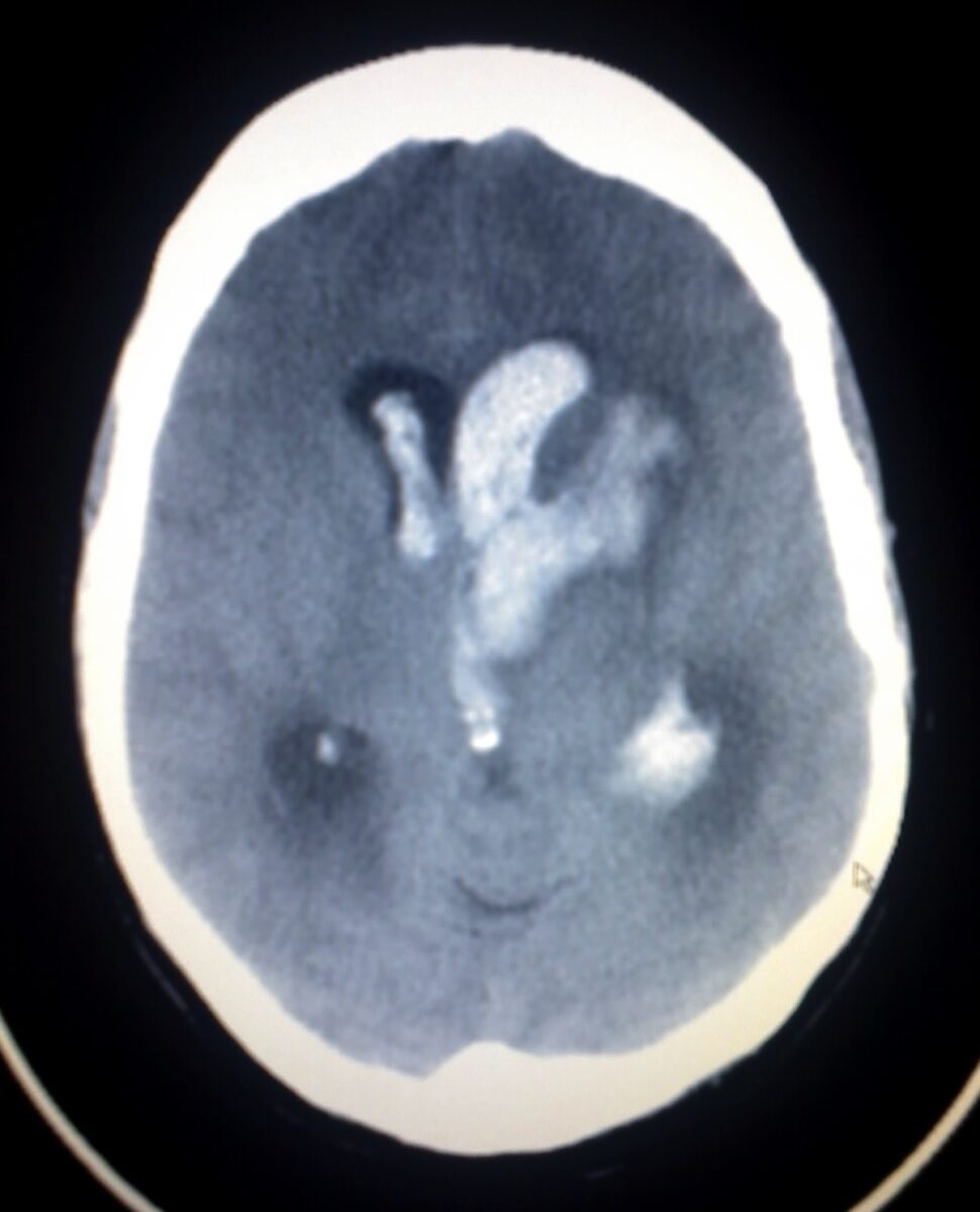 Axial cut of a ct scan of a patient with an intracerebral and intraventricular hemorrhage