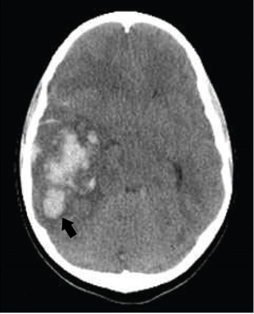 Axial cut of a ct scan of a patient with intracerebral hemorrhage