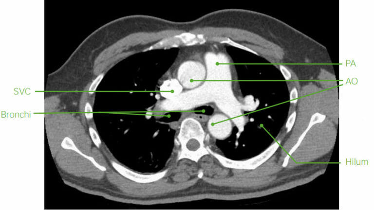 Imaging of the Mediastinum | Concise Medical Knowledge