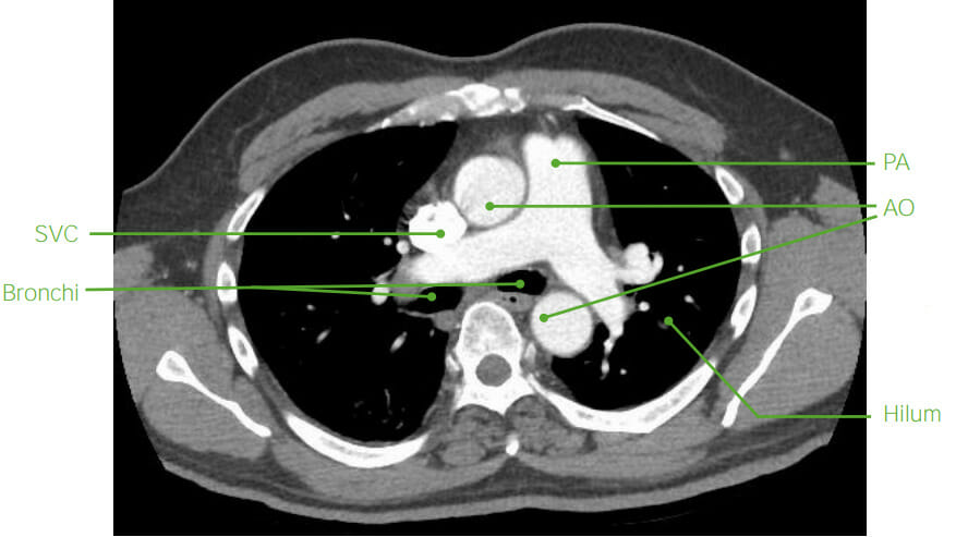 Anatomia mediastinal axial na tc (pós-contraste)