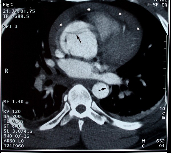 Axial source image of cta reveals the flap in the ascending aorta compatible with type a of stanford dissection
