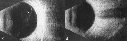 Ultrassonografia b-scan mostrando extensão do descolamento do vítreo.