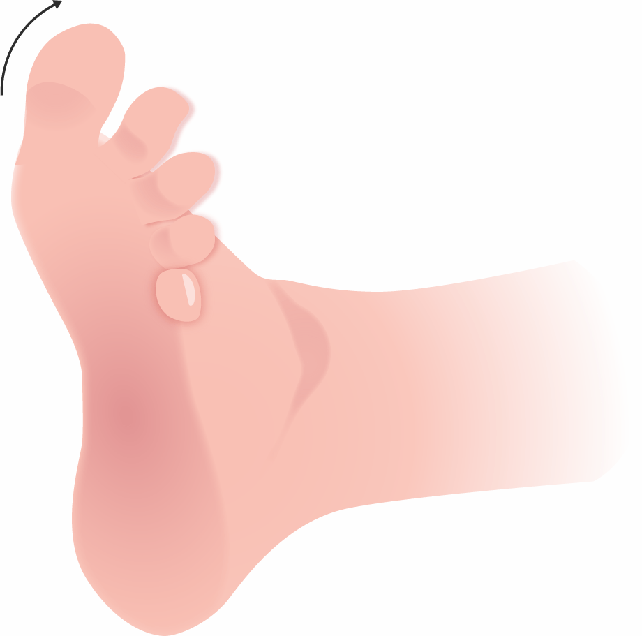 Babinski foot