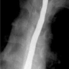 Barium esophagogram