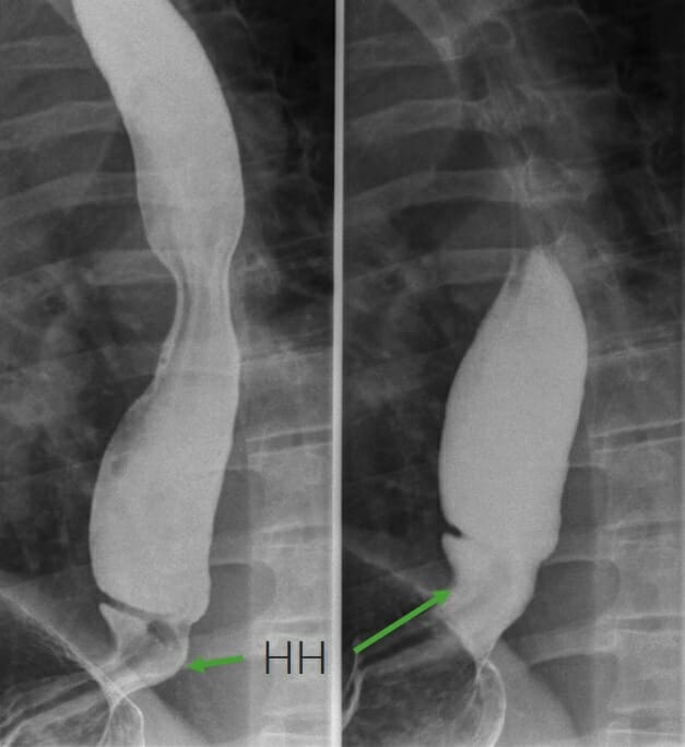 Barium swallow shows a hiatal hernia (arrows)
