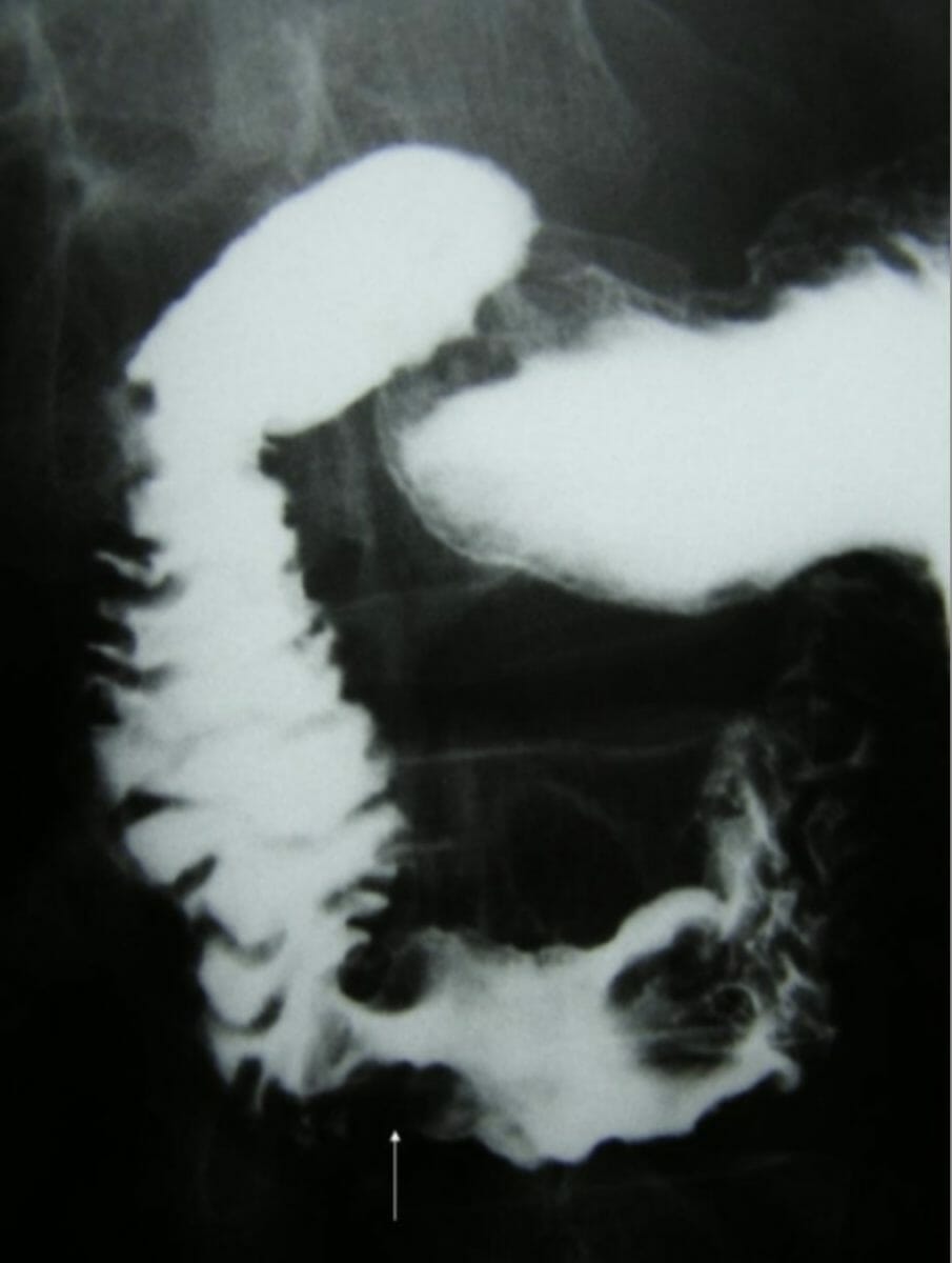 Barium upper gi series showing a stricture