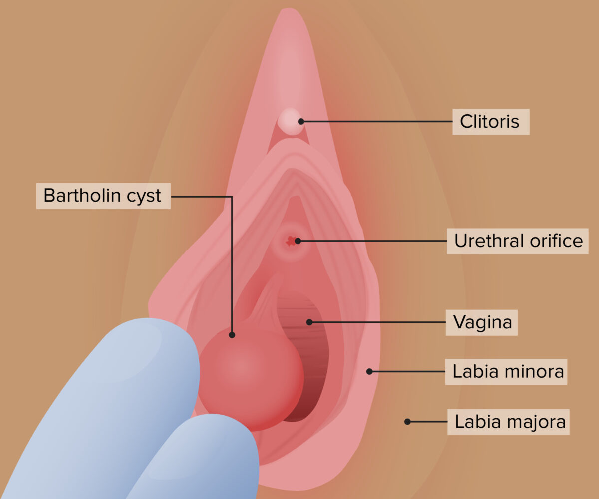Bartholin gland cyst benign vulvar conditions