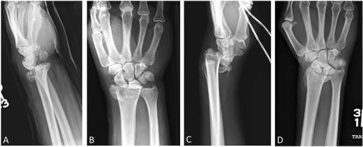 Barton and reverse barton fractures