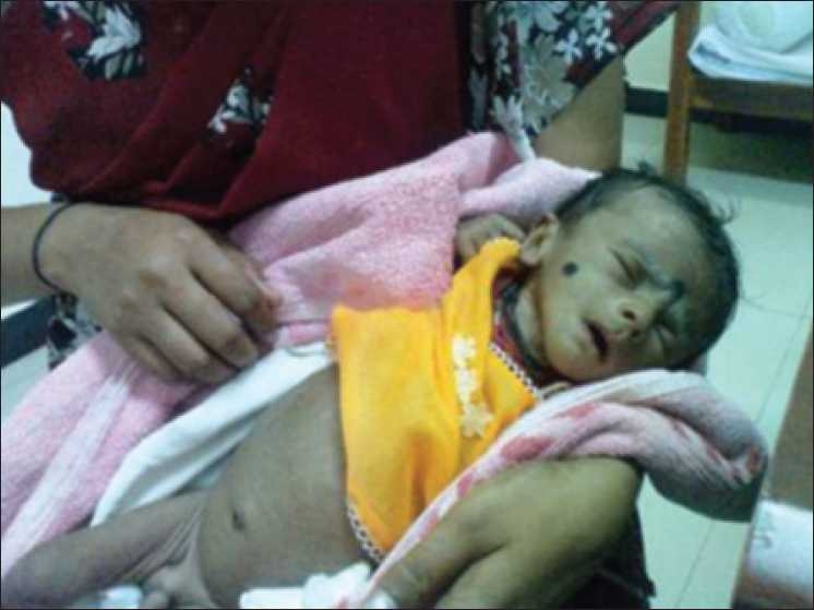 Child with bartter syndrome before treatment