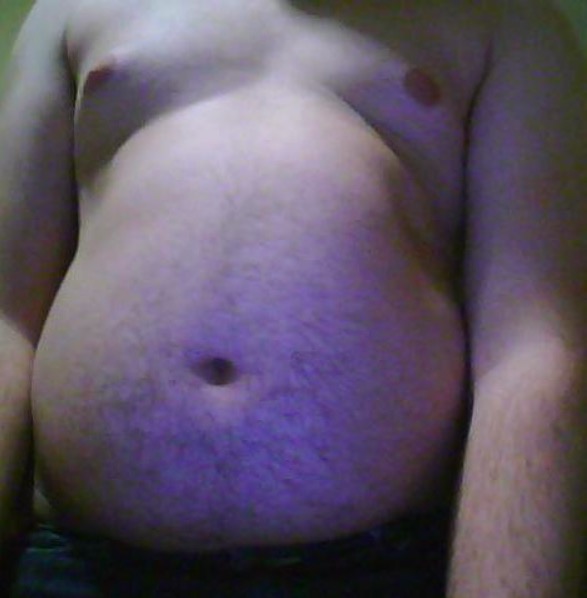Belly of an obese teenage boy