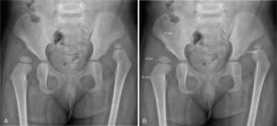 displasia-do-desenvolvimento-da-anca-concise-medical-knowledge