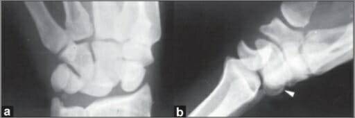 Bilateral dorsal perilunate dislocation of wrist