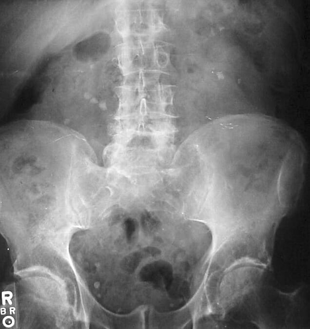 Bilateral kidney stones on abdominal x-ray